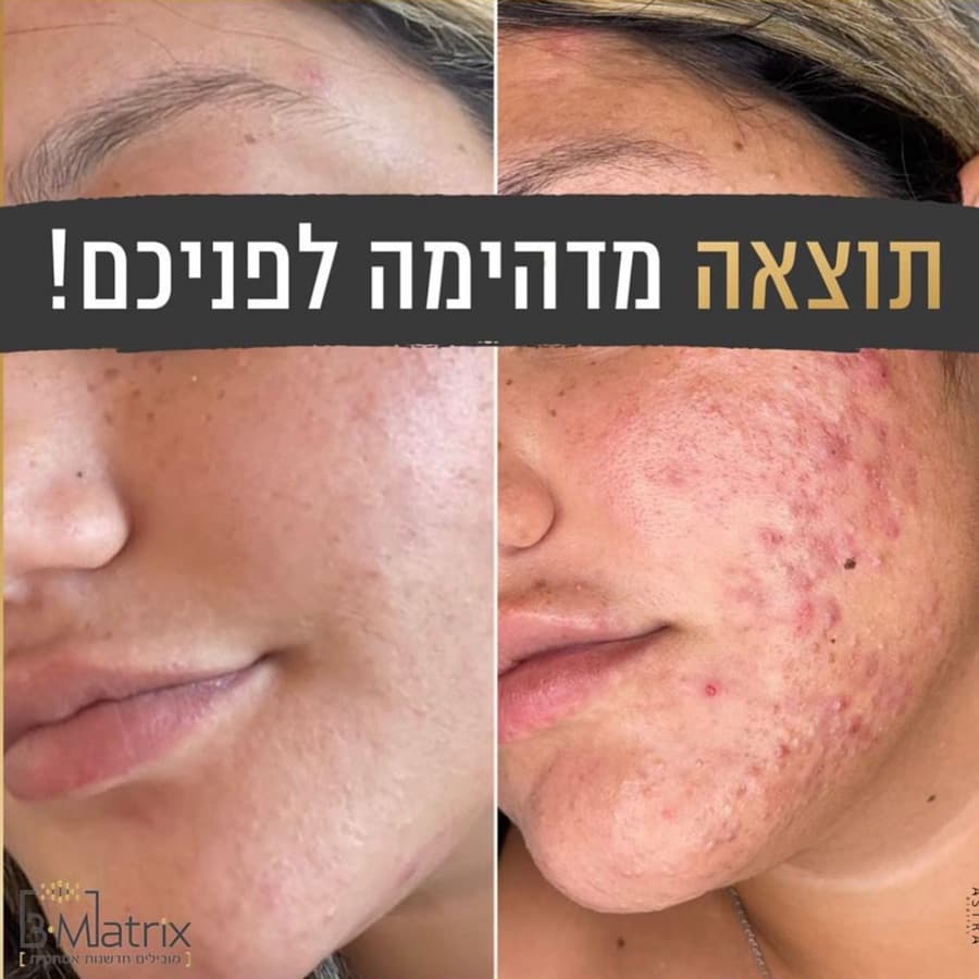 תוצאות טיפול B-Matrix 4
