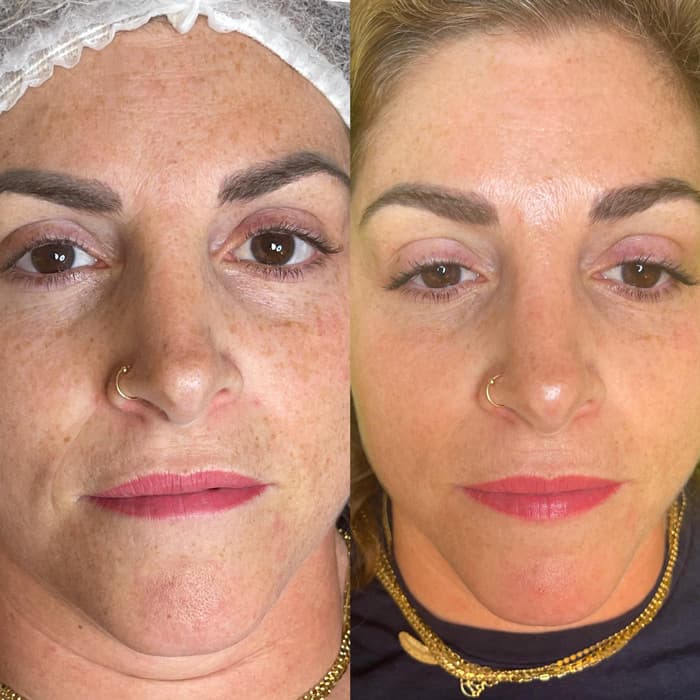 תוצאות טיפול B-Matrix 5