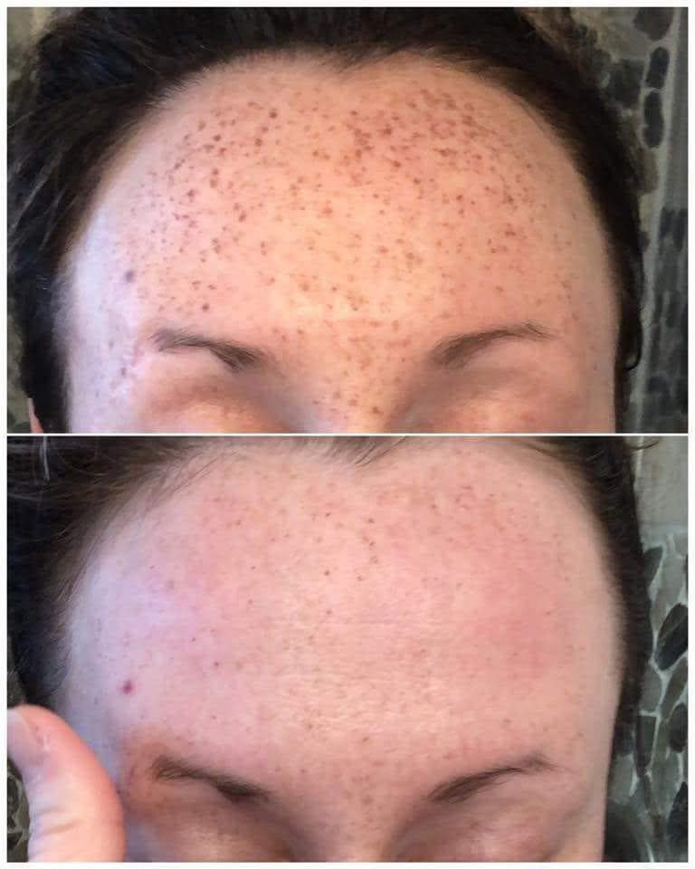 תוצאות טיפול B-Matrix 6